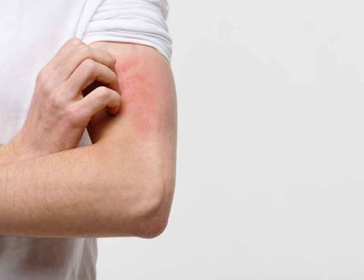 Homme avec une allergie cutanée qui se gratte le bras.